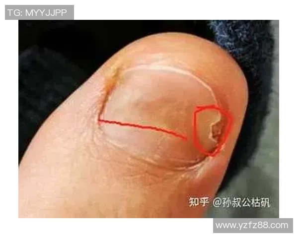 足球灰指甲的成因与预防措施解析助你远离脚部健康隐患